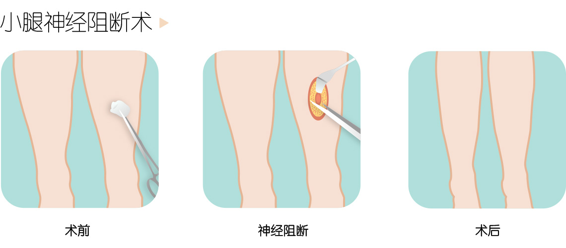 小腿神经阻断术