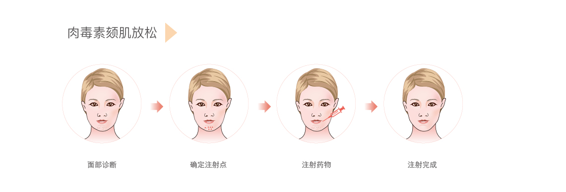 肉毒素放松下巴注射图图片